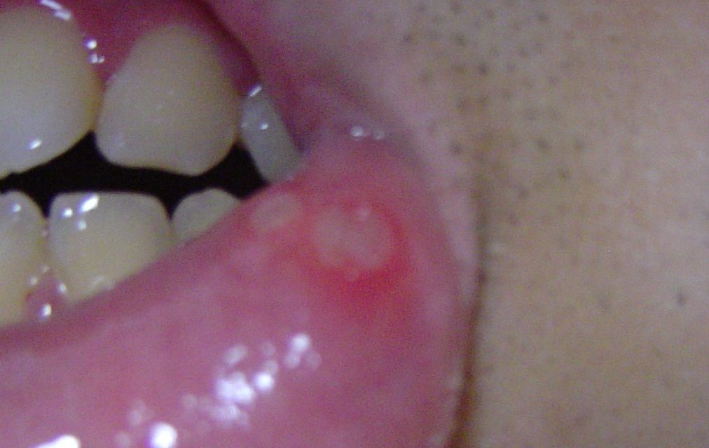 Cold Sores And Canker Sores – The Stress Connection