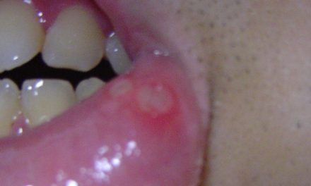 Cold Sores And Canker Sores – The Stress Connection