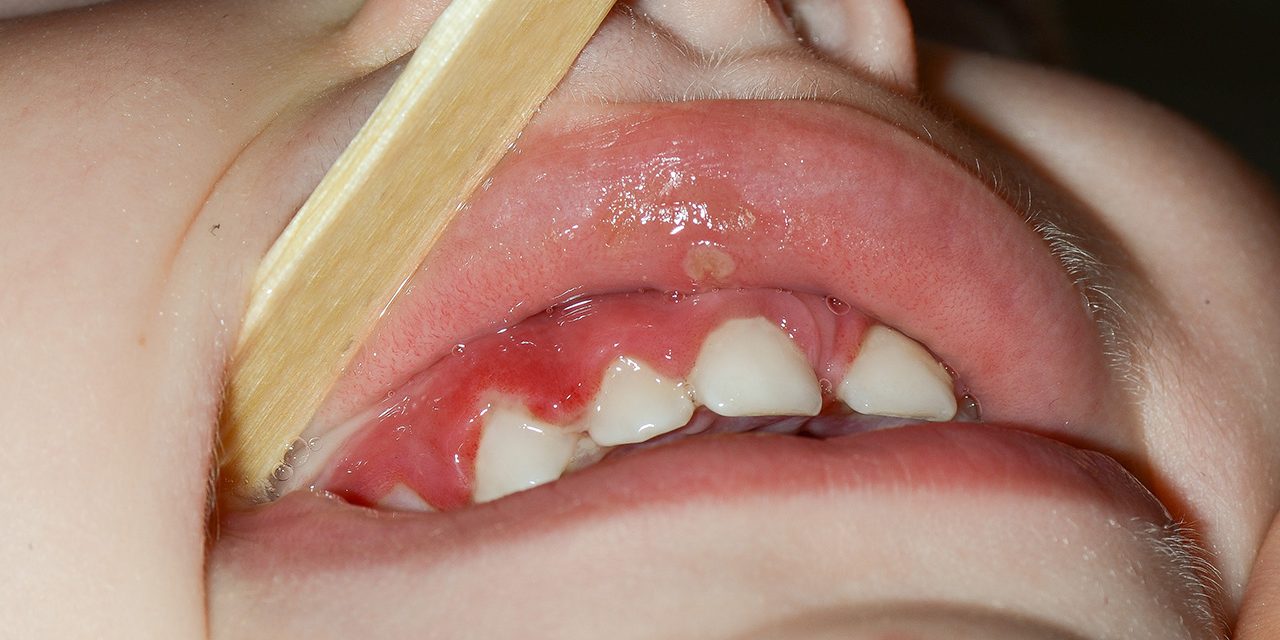 Autoimmune Disease of the Mouth