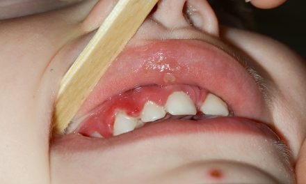 Autoimmune Disease of the Mouth