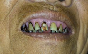 poor dental care and also poor diet