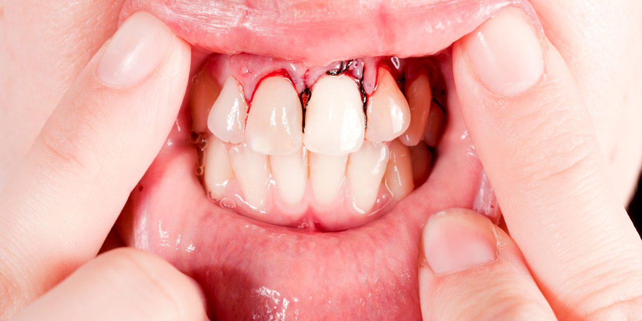 Prevention Of Periodontal Disease