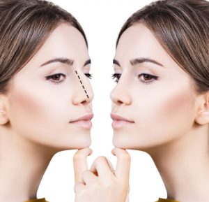Rhinoplasty Before And After