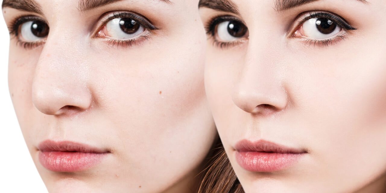 Effects Of Rhinoplasty Before And After Surgery