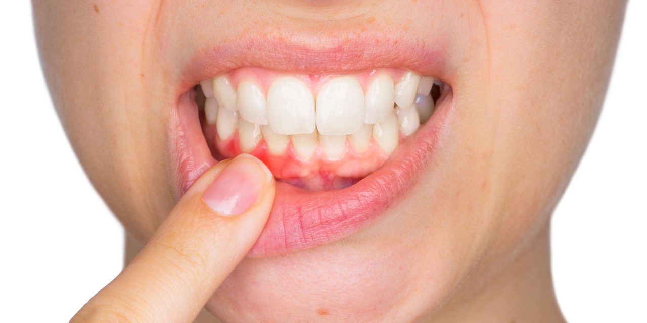Itchy Gums And Its Causes