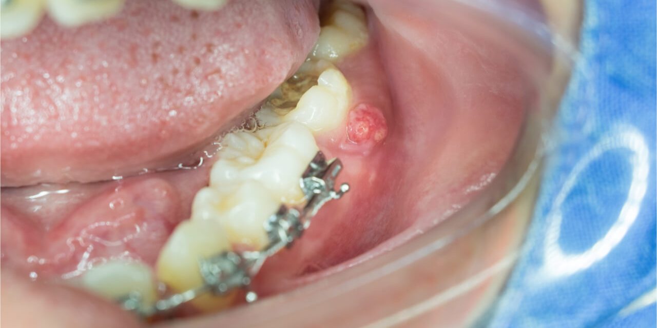 What are the root canal infection symptoms?