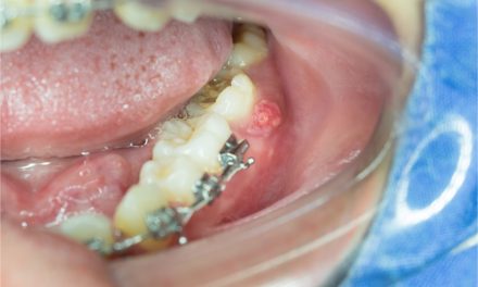 What are the root canal infection symptoms?