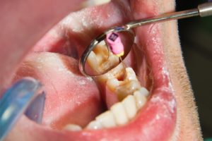 root canal infection symptoms