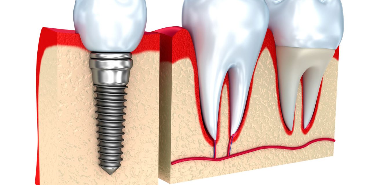 Temporary Dental Crown