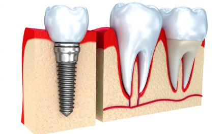Temporary Dental Crown