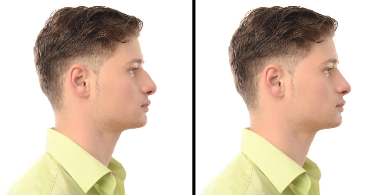 Male Rhinoplasty
