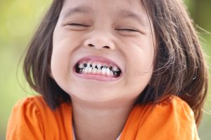 kids tooth decay