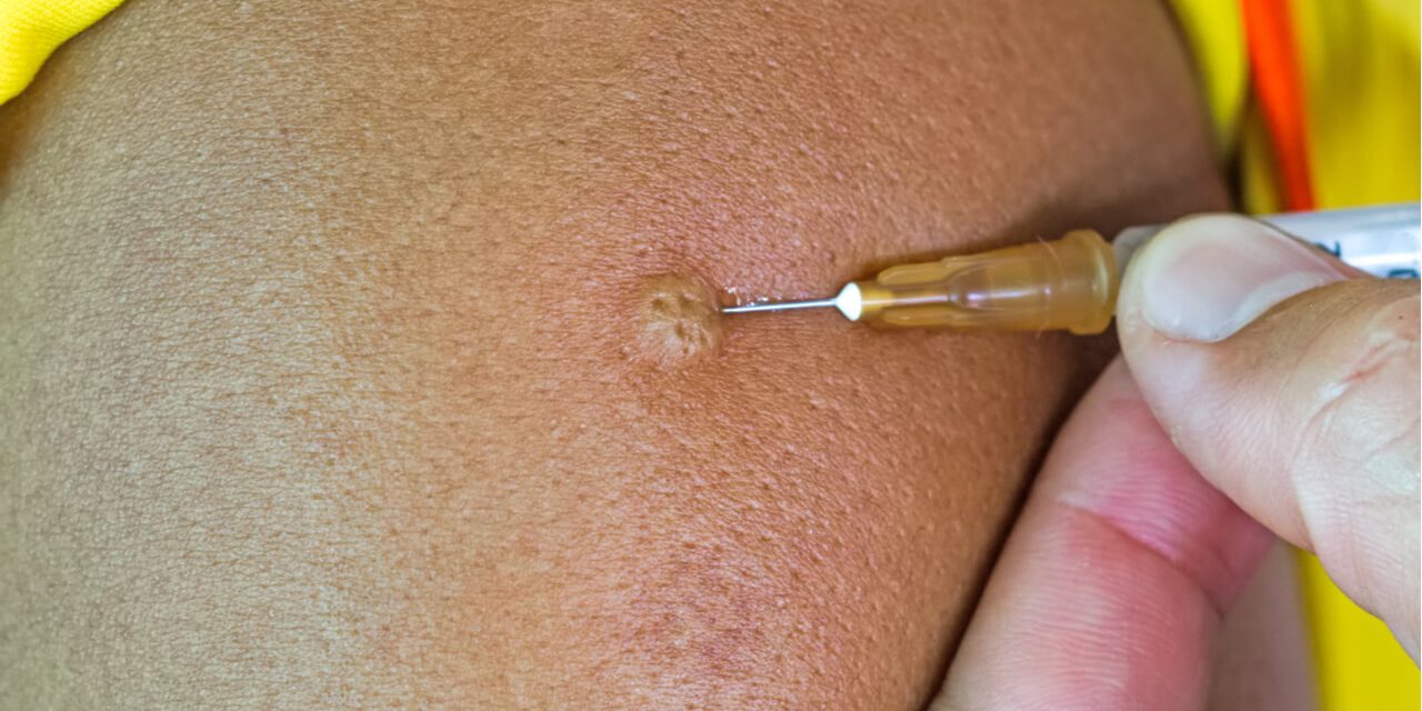 What is intradermal flu vaccination?
