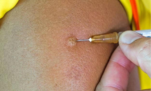 What is intradermal flu vaccination?