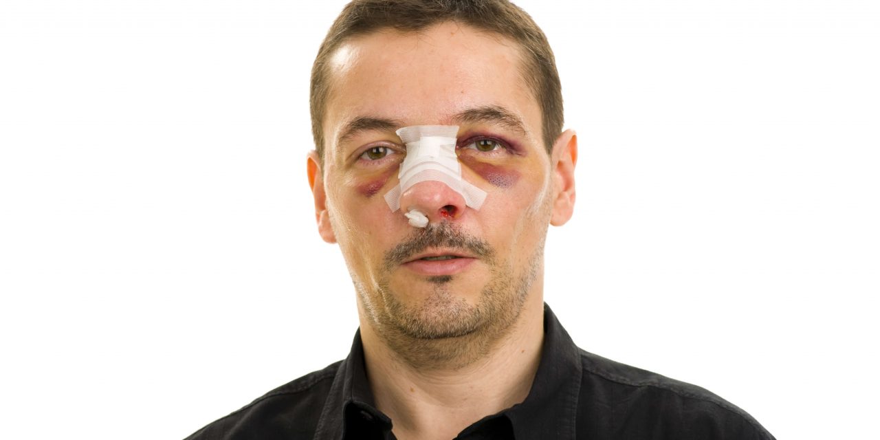 Nasal fracture