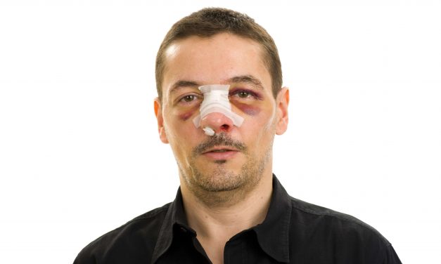 Nasal fracture