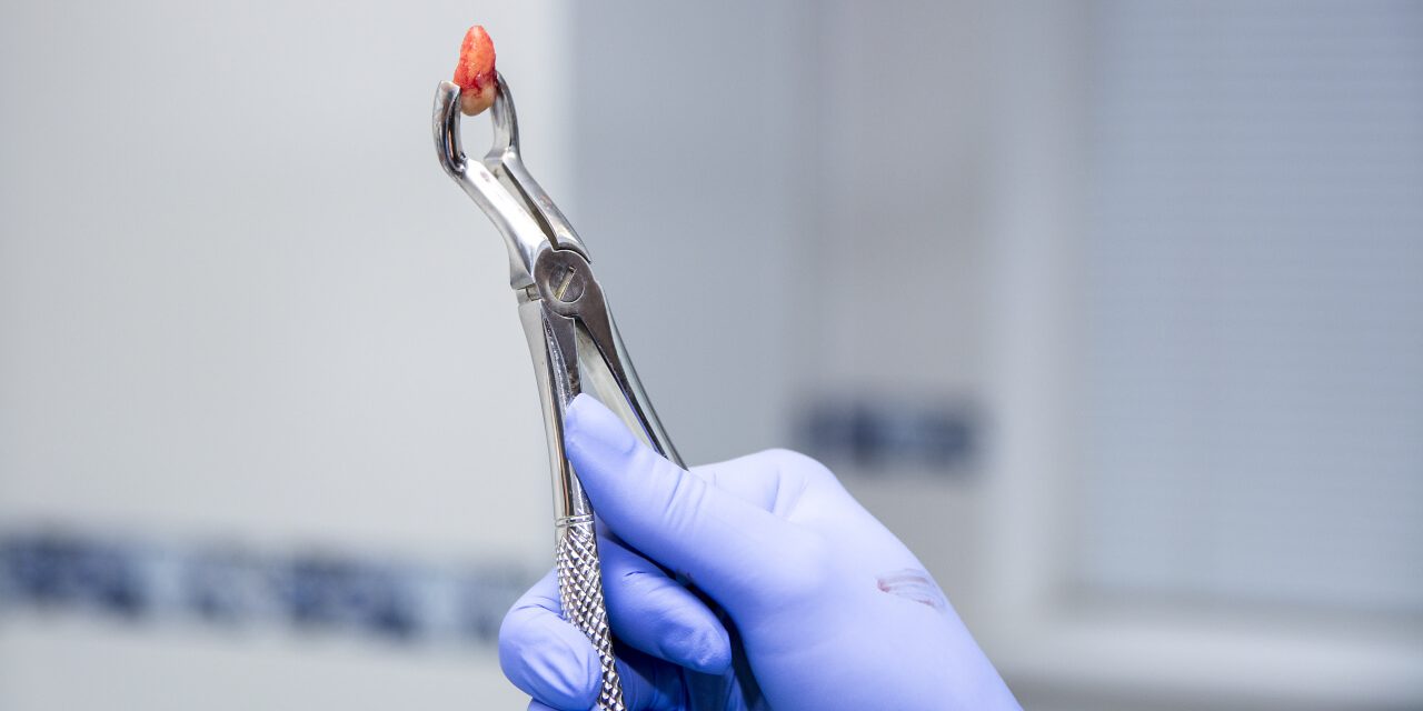 Wisdom tooth removal