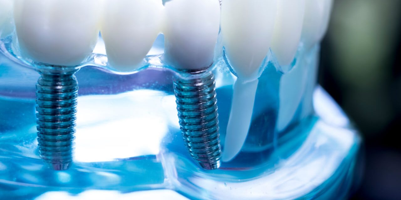 Simplification of Implant Dentistry