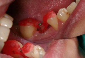 Tooth Extraction And Implant At The Same Day