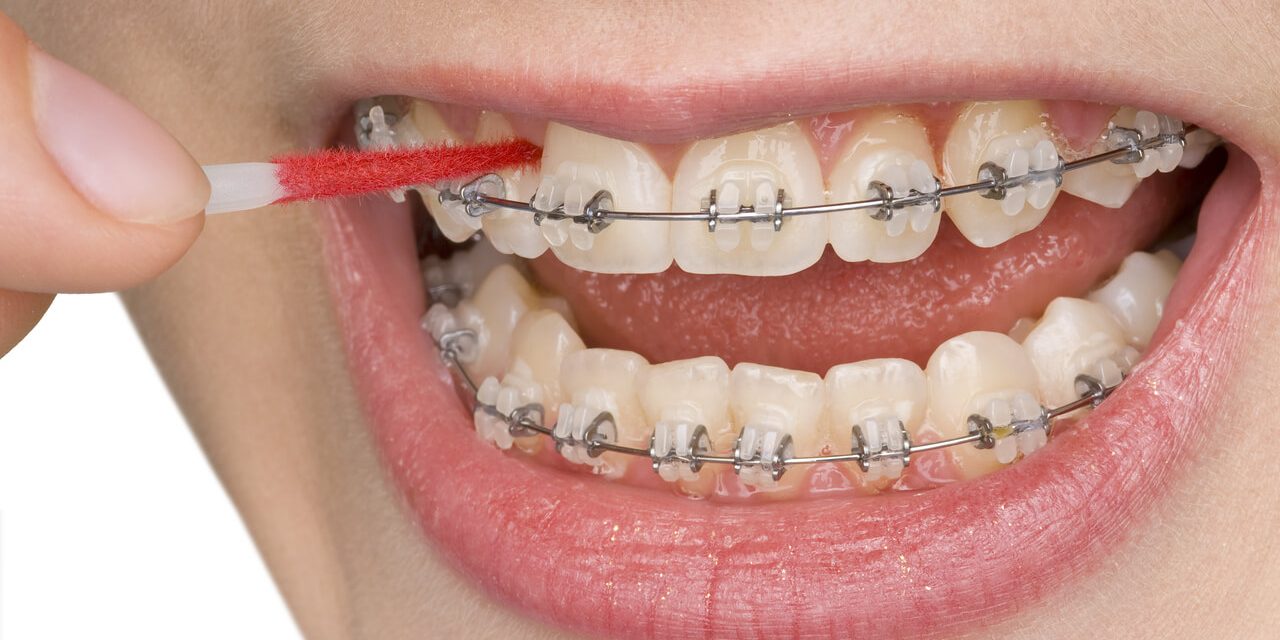 Teeth cleaning with braces: How it can effectively be done