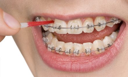 Teeth cleaning with braces: How it can effectively be done