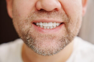 teeth discoloration vitamin deficiency