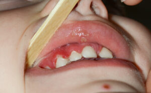 most oral fibromas periodontal abscess focal fibrous hyperplasia