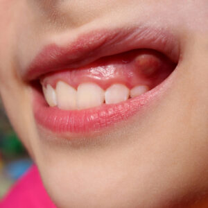 oral fibroma symptoms remove oral fibroma