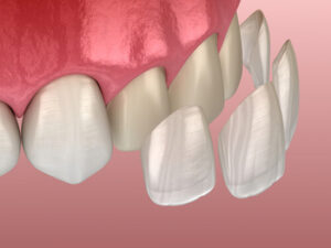 dental veneers before and after application