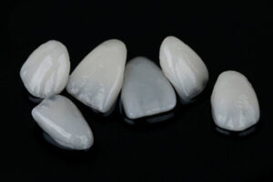 dental veneers before and after shells